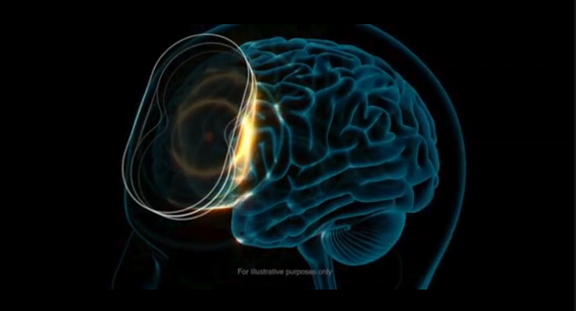What is TMS?